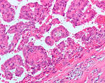 File:<b>Papillary</b> renal cell