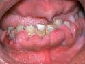 Red, White, and Blue…..Gums « Dentist Inver Grove Heights, MN| IGH ...
