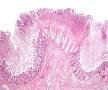 Colectomy - Wikipedia, the free encyclopedia