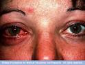 Pink eye (<b>conjunctivitis</b>) is