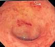 Ulcerative colitis - Wikipedia, the free encyclopedia