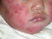 Atopic eczema, atopic dermatitis. DermNet NZ
