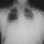 Severe high altitude pulmonary oedema: a patient managed ...