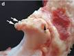 Osteophyte - Wikipedia, the free encyclopedia