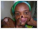 A Noma sufferer recovers from