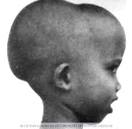 β-Thalassemia Trait: