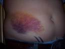 How to Stop Bruises from Hurting