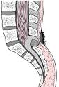 <b>Spina bifida</b> occulta.