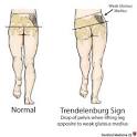 This <b>gait</b> is seen in patient