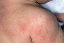 Picture of Heat Rash 