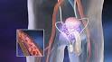BPH Diagnosis and Treatment - Alpha-blockers for BPH