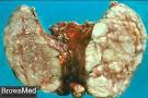 Hashimoto disease