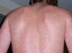 Itchy Rash 