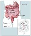 colon and rectal cancer