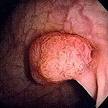 230px-Polyp-2.jpeg