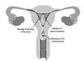 MIRENA® (levonorgestrel-releasing intrauterine system)