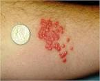 Bed Bug Bite