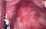 Erythematous Candidiasis