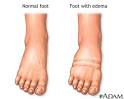 LEG SWELLING