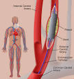 Weill Cornell Cardiology - Treatment for Carotid Artery Disease ...