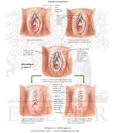 Female Circumcision - Netter Medical Images