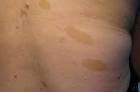 <b>Manchas café</b> con <b>leche</b>