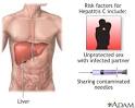 Hepatitis C: MedlinePlus Medical Encyclopedia Image