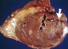 Myocardial <b>rupture</b> pathophysiology - wikidoc
