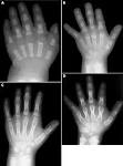 Acrocapitofemoral dysplasia: an autosomal recessive skeletal