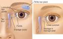 <b>Tear Duct</b> Infection