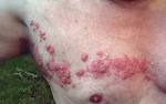 File:Herpes zoster chest.png - Wikimedia Commons