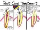 Is Root Canal Treatment Painful?