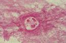 Burkholderia cepacia: Friend or Foe?