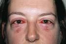  Conjunctivitis - The Clinical Advisor