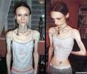 Medusa: ANOREXIA: LAUREN BAILEY BATTLES BACK FROM THE BRINK TO ...
