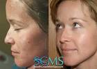 Laser Acne Scar Removal Los Angeles - San Diego Acne Scar Treatment - young_caucasian_female_large