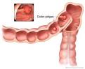 Adenomas - Digestive HealthCare Center, physicians specializing in ...