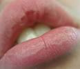 Chapped lips are caused