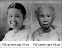 Werner Syndrome