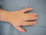 Clinical Example: <b>Syndactyly</b>