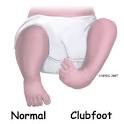 A Patient's Guide to Clubfoot