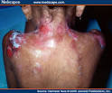 epidermolysis bullosa