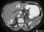 <b>Ovarian Neoplasms</b>