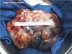 of all <b>ovarian neoplasms</b>.