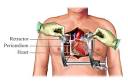Open Heart Surgery - procedure and recovery | Health Dictionary