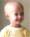 Hutchinson-Gilford progeria