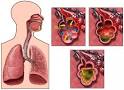 Bacterial Pneumonia – Symptoms, Treatments and Prevention ...