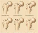 Hip Fractures in Adults - February 1, 2003 - American Family Physician