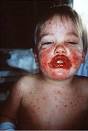 Aree <b>di</b> mucosa orale con