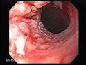 <b>Esophageal cancer</b> is a